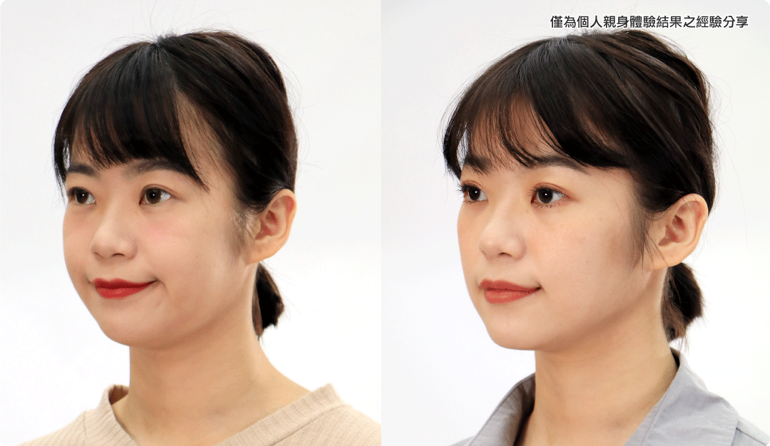 消脂針案例