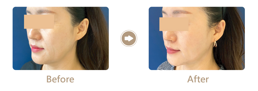 電音波拉提案例