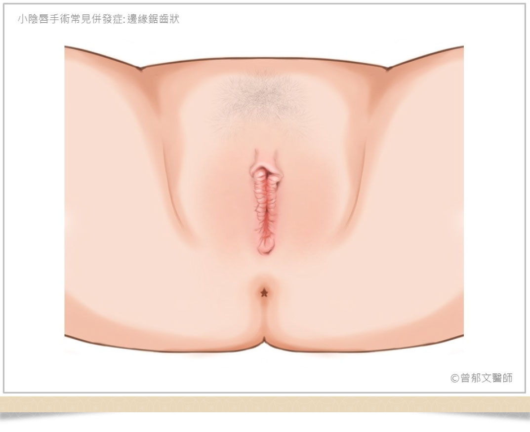 小陰唇手術併發症鋸齒狀