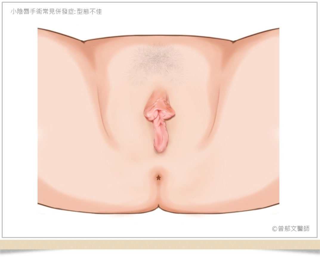 小陰唇手術併發症型態不佳
