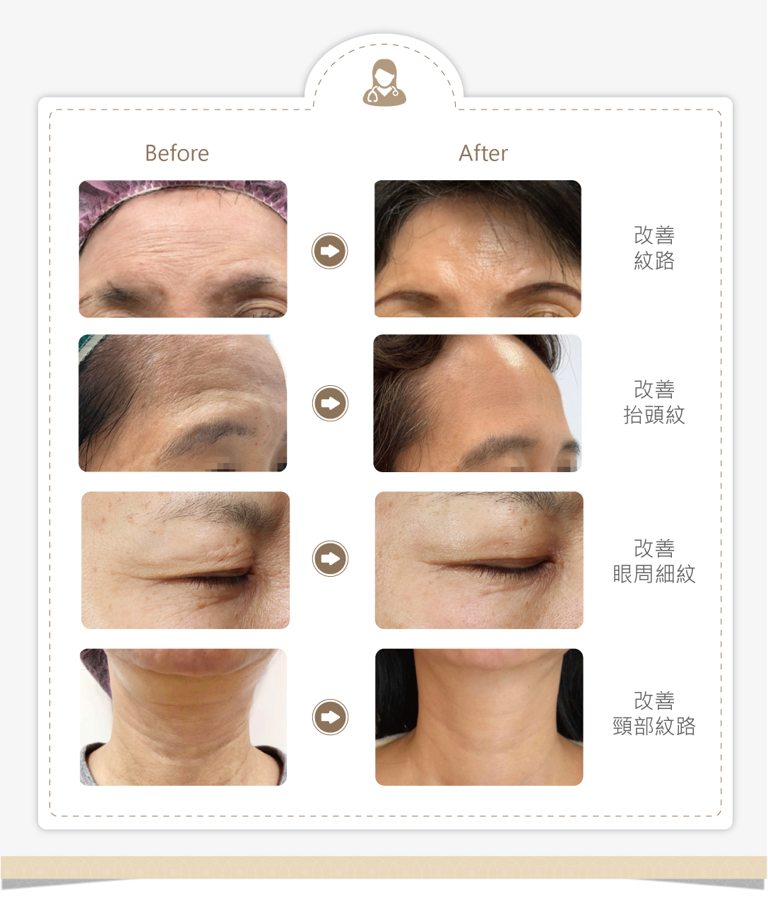 眼下細紋醫美療程推薦提可塑：改善抬頭紋