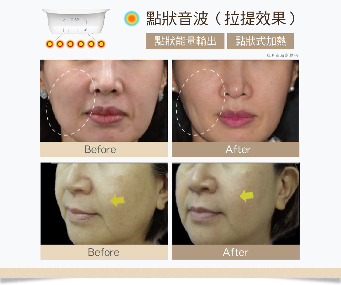 Q+立線音波點狀式加熱拉提