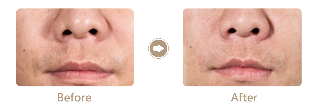 消除法令紋木偶紋案例