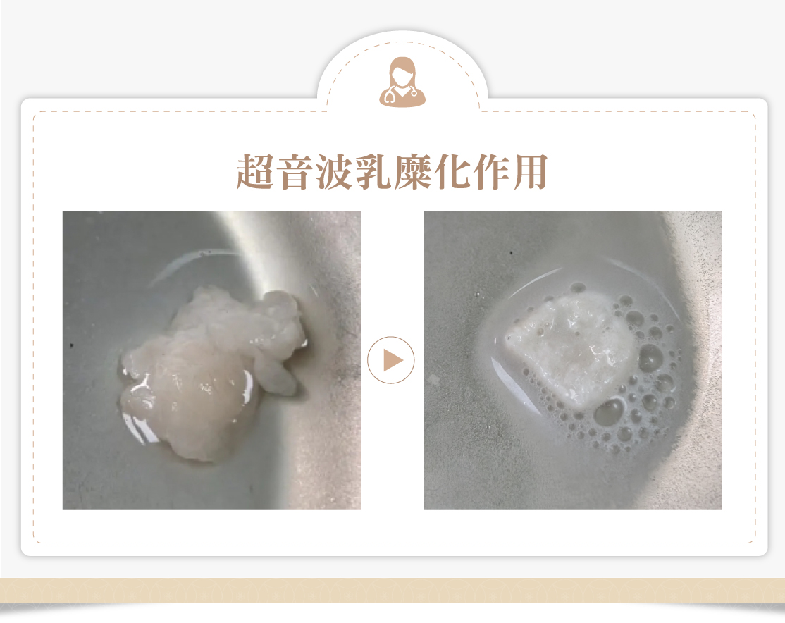 超音波脂肪乳糜化