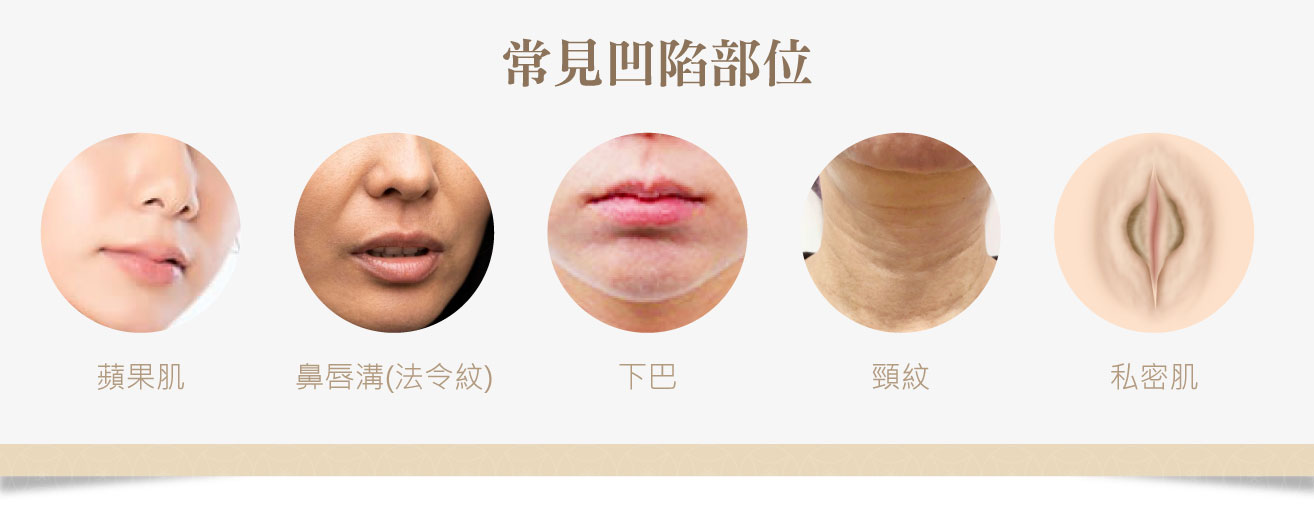 異體真皮粉施打部位