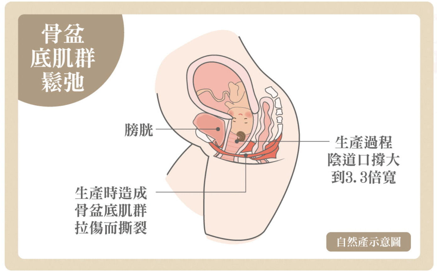 自然產的產後漏尿風險更大