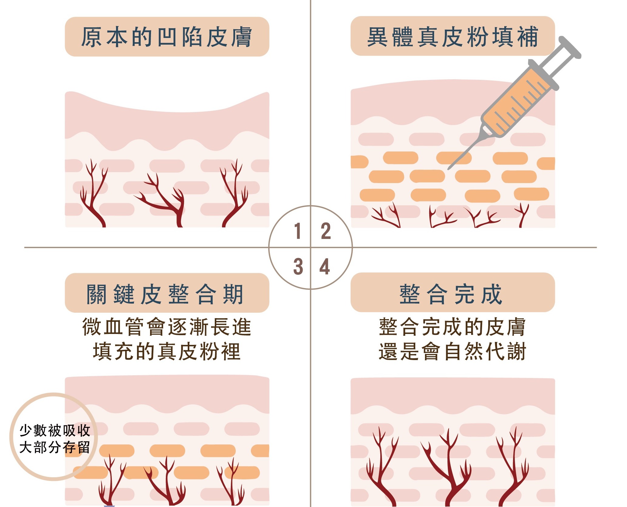 異體真皮粉可以維持多久