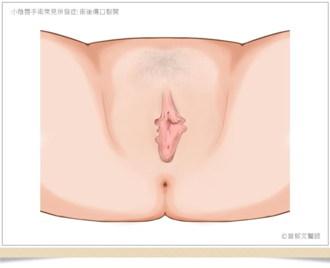 小陰唇手術併發症傷口裂開
