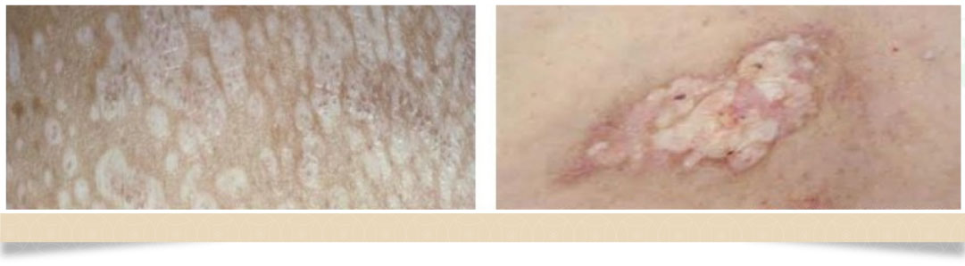 外陰硬化性苔癬白斑