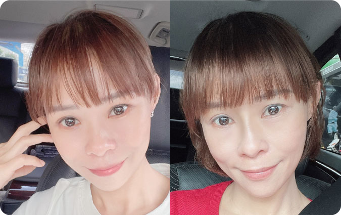 鼻雕案例