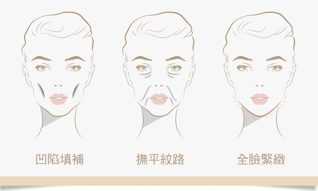 玻尿酸臉部凹陷