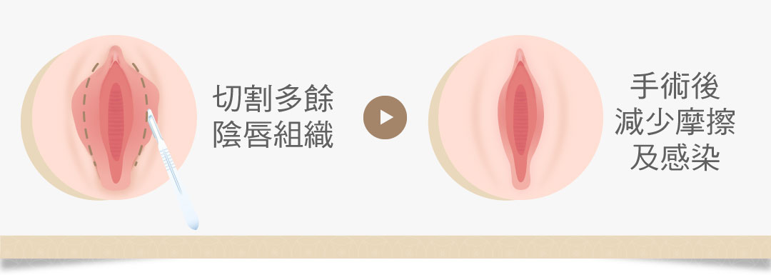 小陰唇切除 小陰唇手術 小陰唇摩擦  私密感染