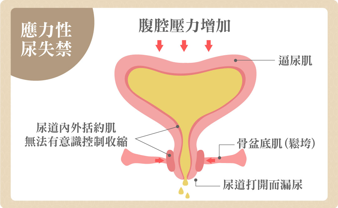 應力型尿失禁漏尿