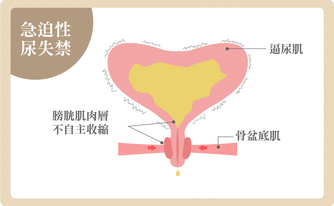 急迫型尿失禁漏尿