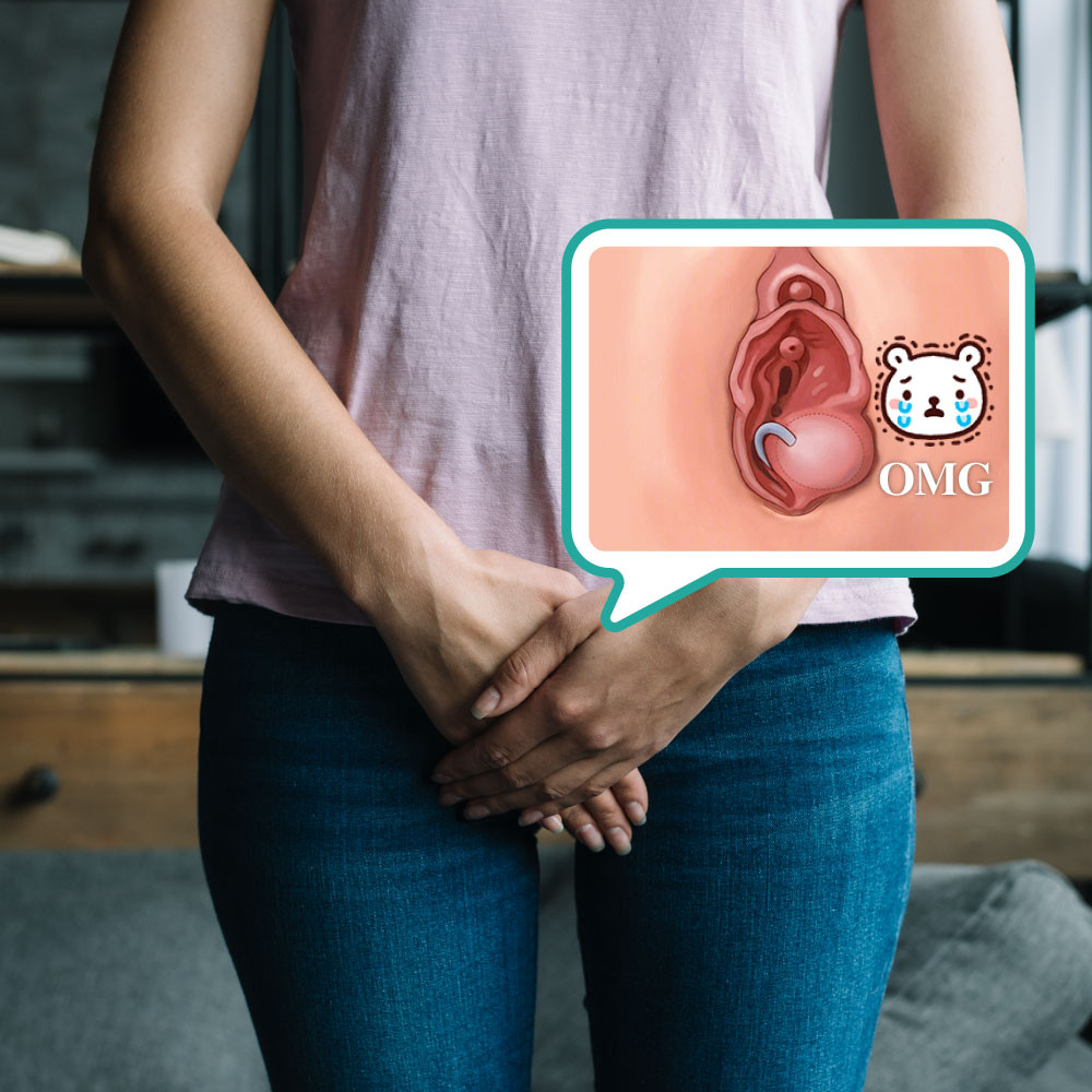 雷射巴氏腺囊腫造袋手術