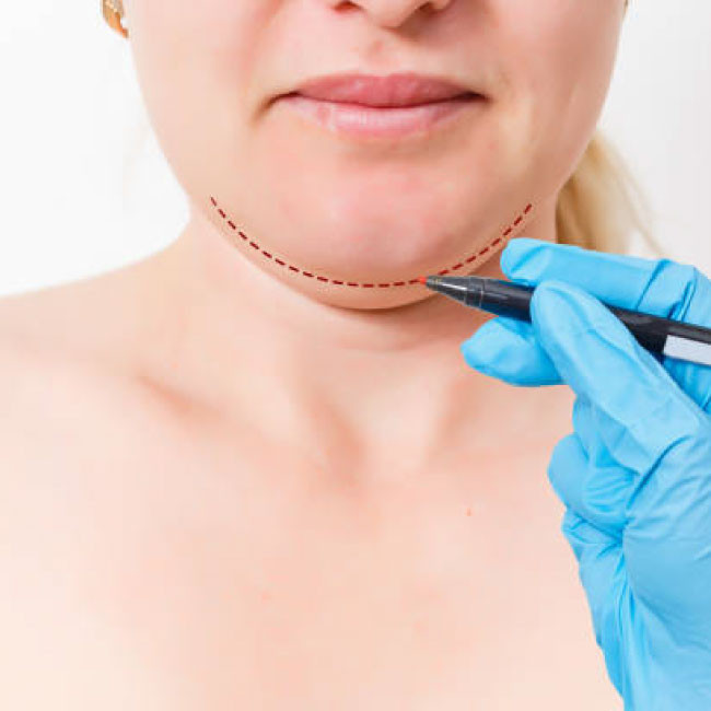 【華人健康網專訪】有雙下巴是因為「胖」? 醫：雙下巴不等於胖，搞懂成因才能對症治療 !