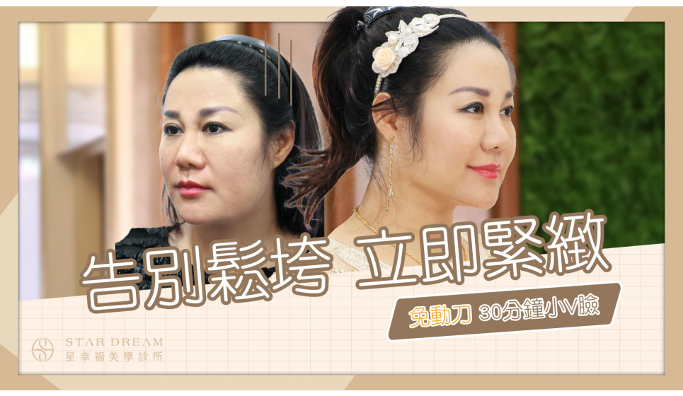 臉鬆鬆老10歲，驚人? 只要30分鐘線雕拉提，立即緊緻