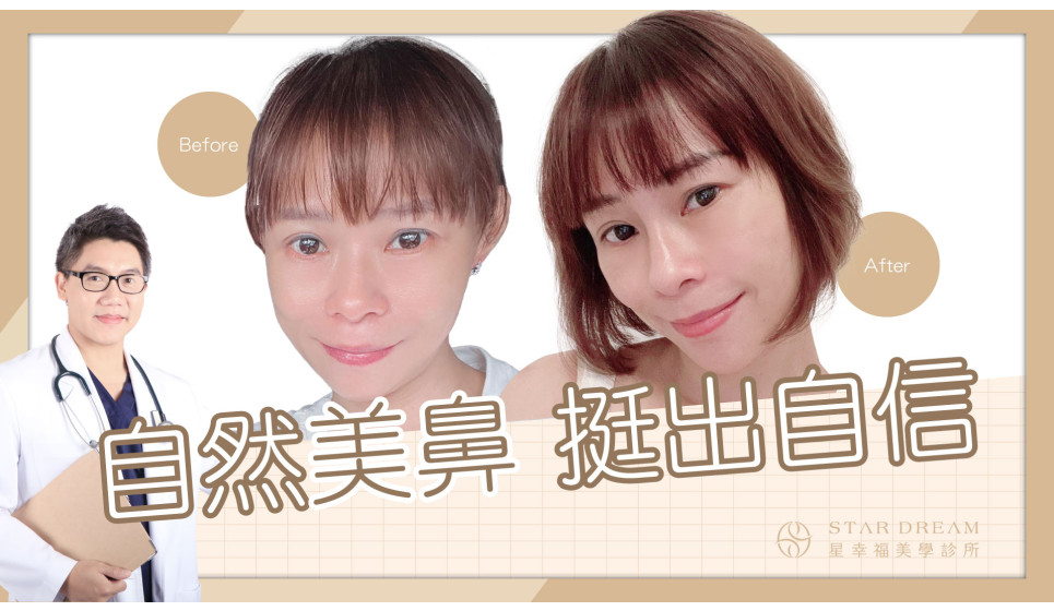 玻尿酸不持久的原因居然是XX 鼻雕無痛感自然美鼻挺出自信 | 雲曉權醫師