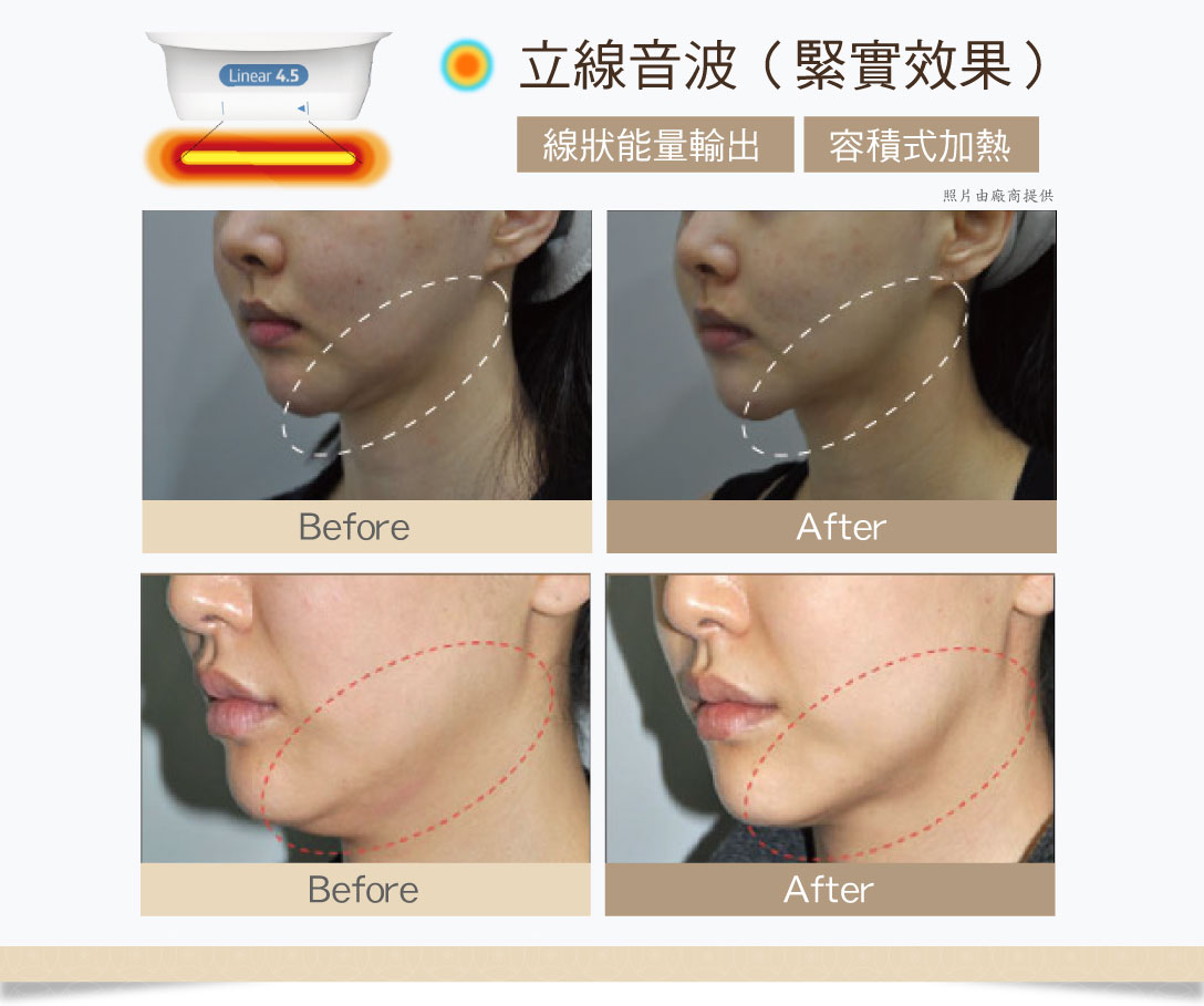 Q+立線音波容積式加熱緊實