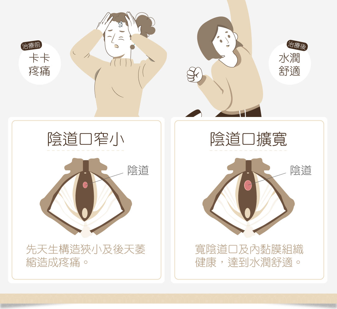 陰道口擴張手術