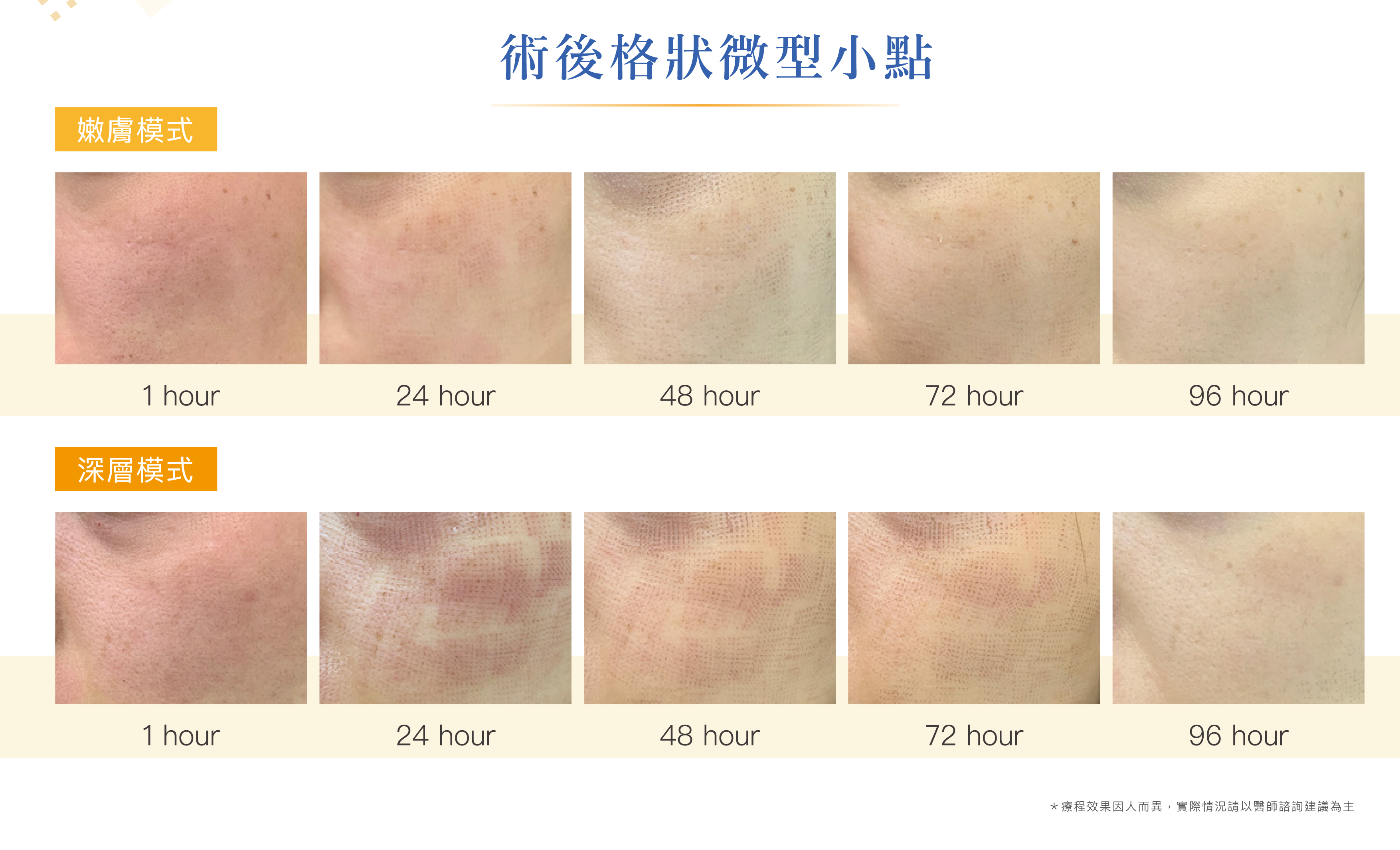 細紋剋星 Tixel2提可塑