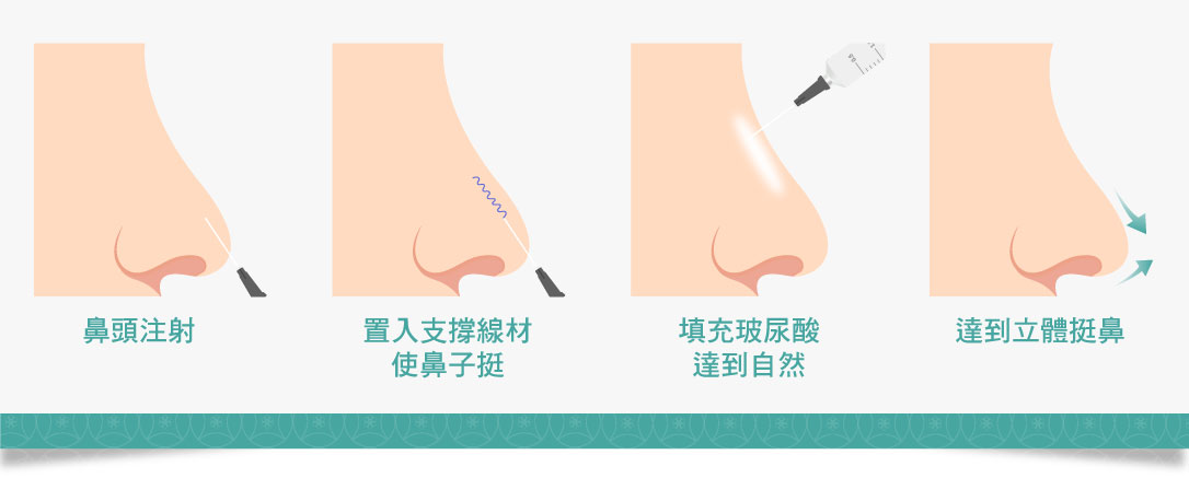 鼻雕線流程