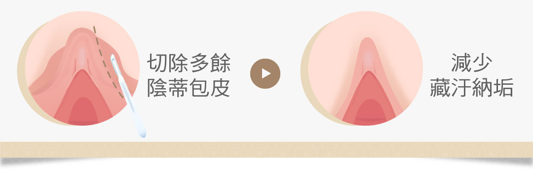 陰蒂包皮